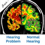 Brain with Hearing Loss.